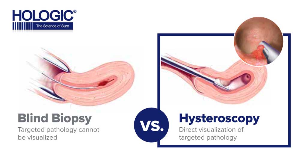 Hologic MyoSure Direct Visualization Infographic - Social Graphic 3